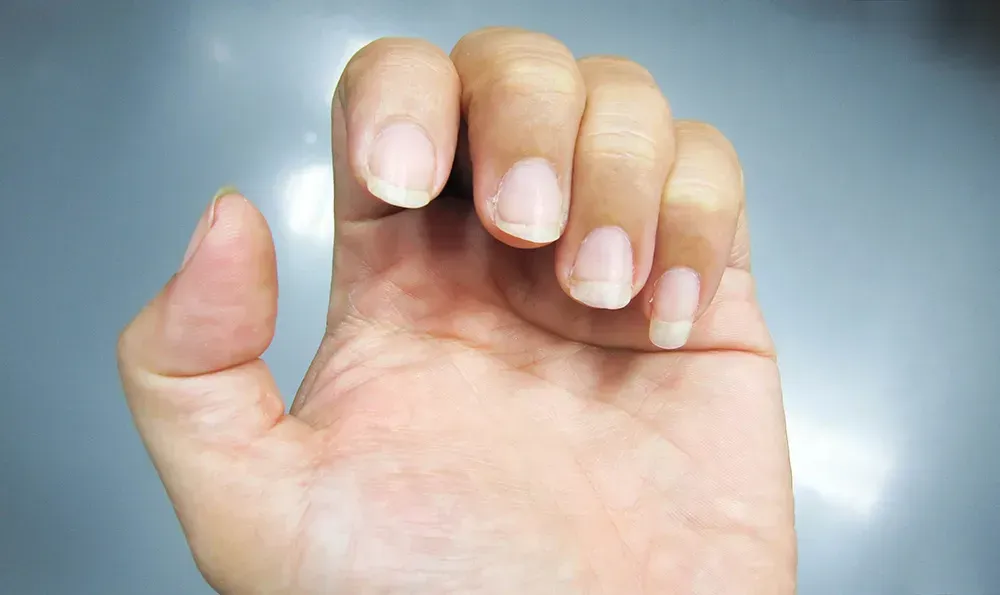 Unhealthy looking nails.